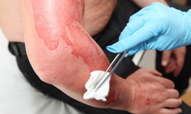 How Are Burn Injuries Evaluated?